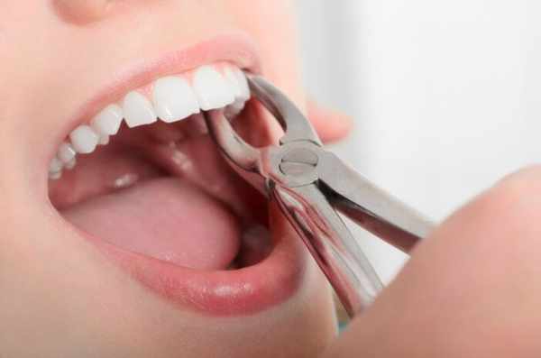 6 Cara Mempercepat Penyembuhan Setelah Cabut Gigi